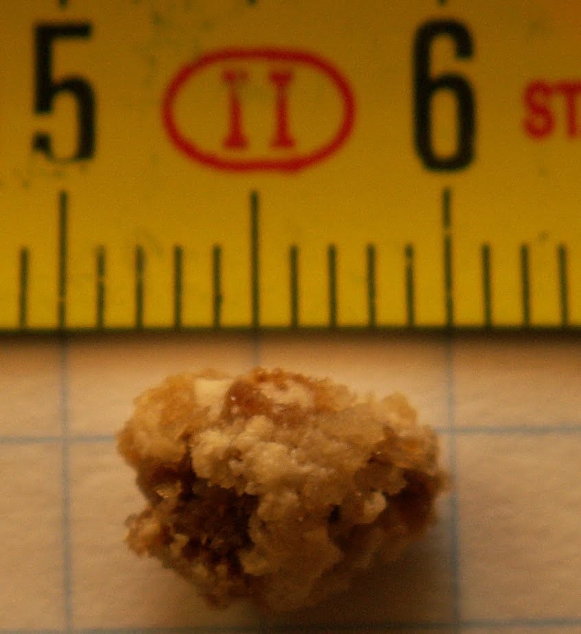 My Second Kidney Stone Attack
