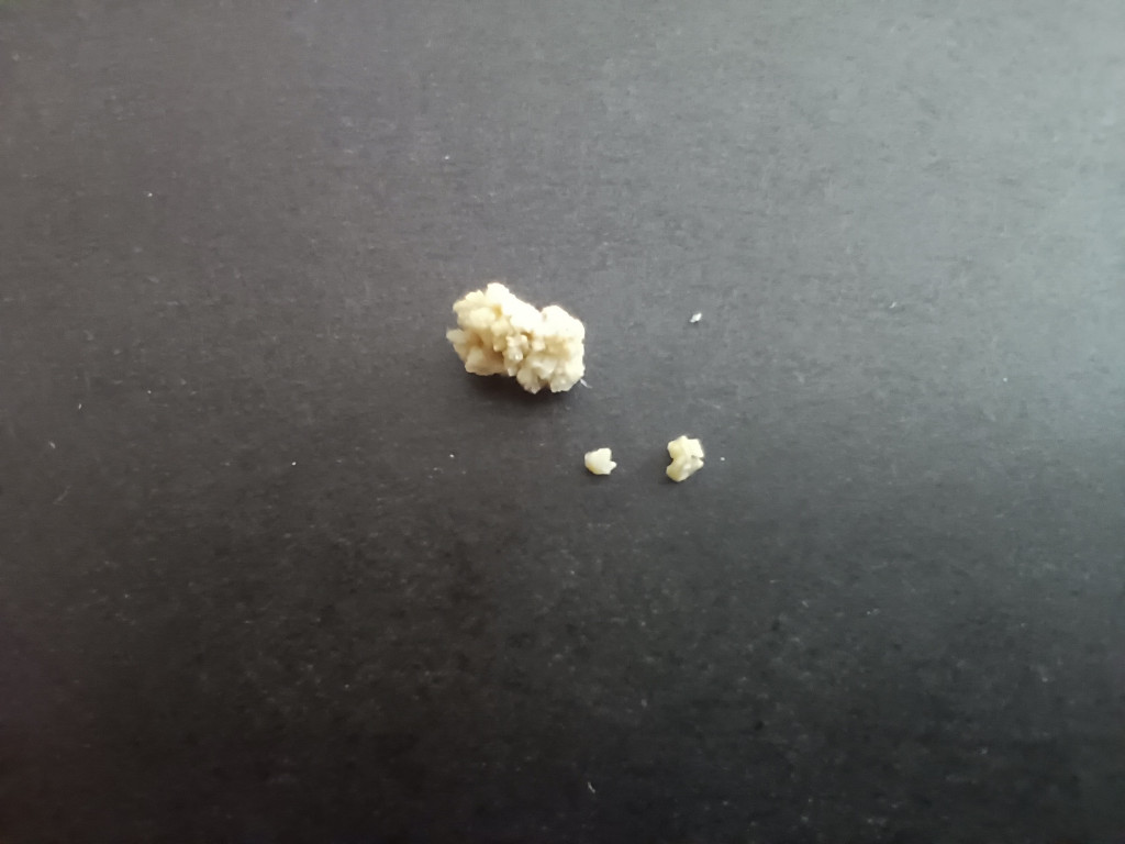 Not Again! - Kidney Stone 3